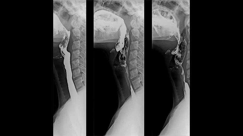A fluoroscopic image showing barium contrast moving through a patient's esophagus during a swallow study