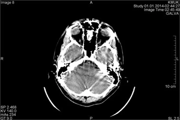 An image with a clear motion or metal artifact